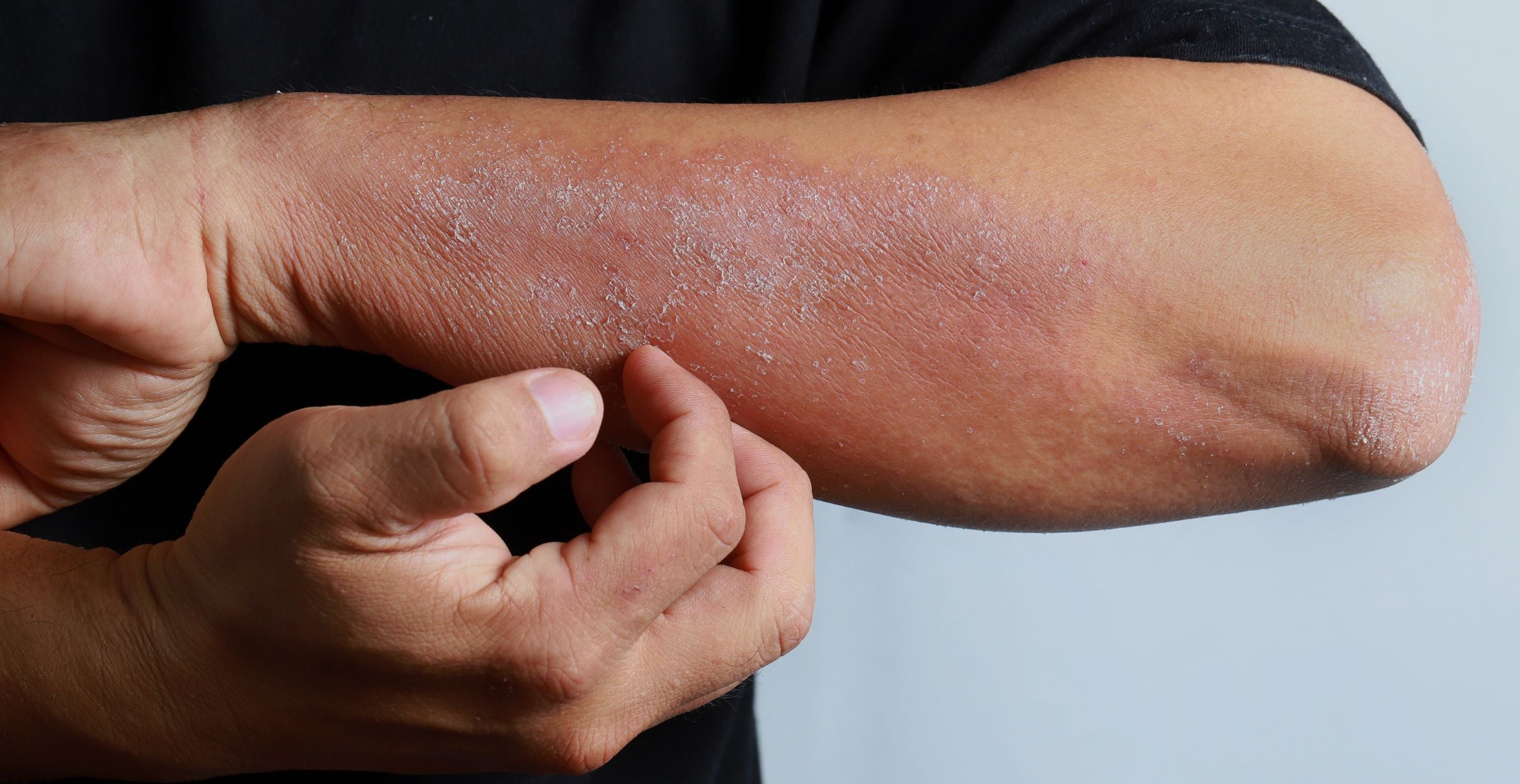Managing Atopic Dermatitis: Tips for Effective Recovery
