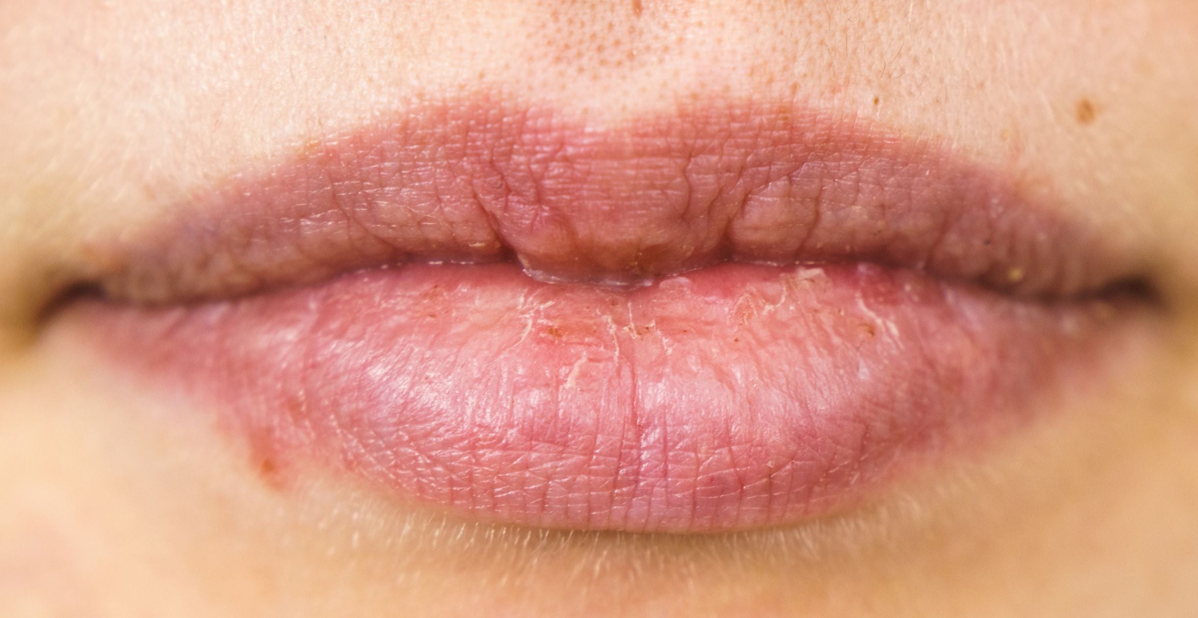 How to Get Rid of Pimple on Lip: Tips and Tricks