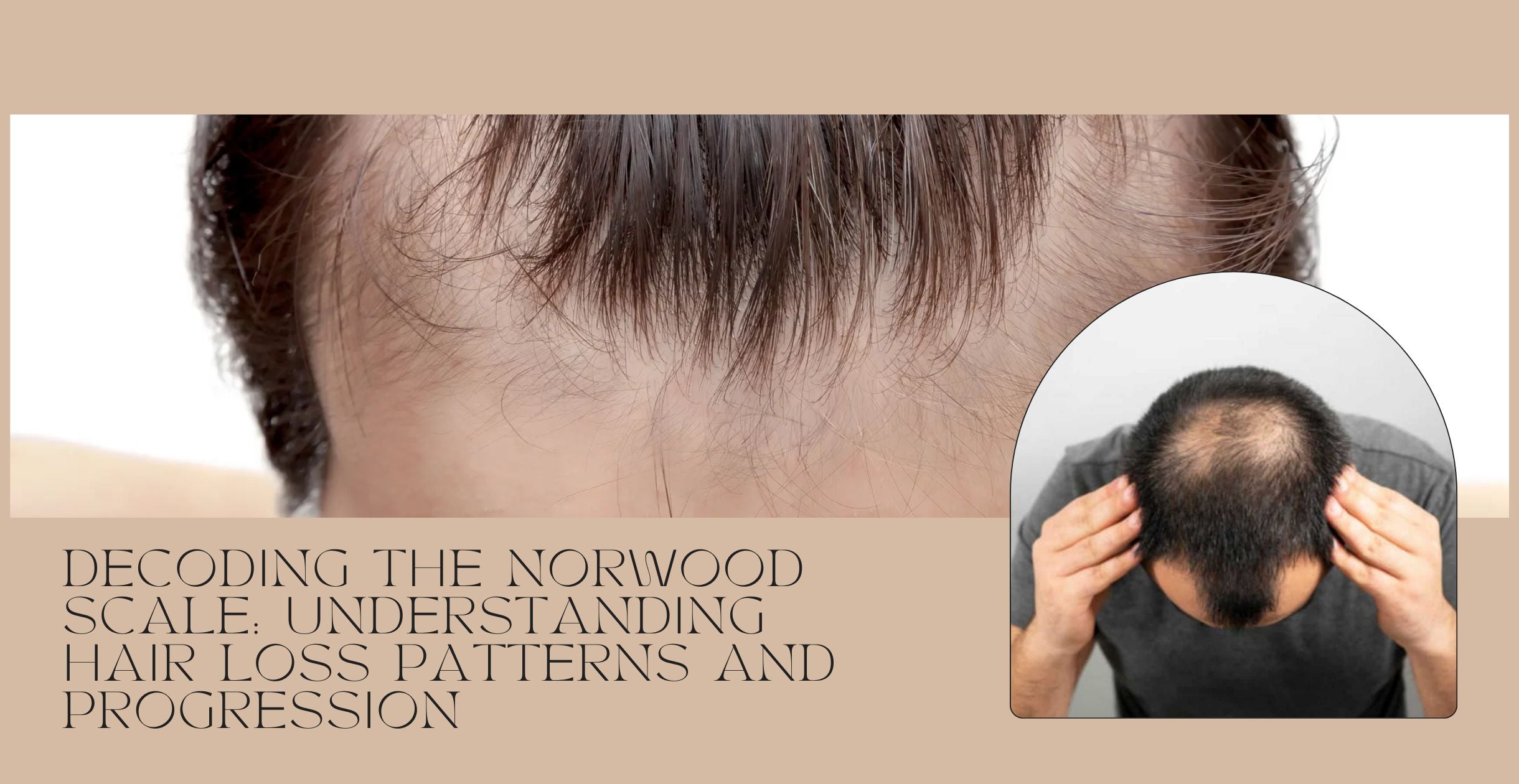 Decoding the Norwood Scale: Understanding Hair Loss Patterns and Progression
