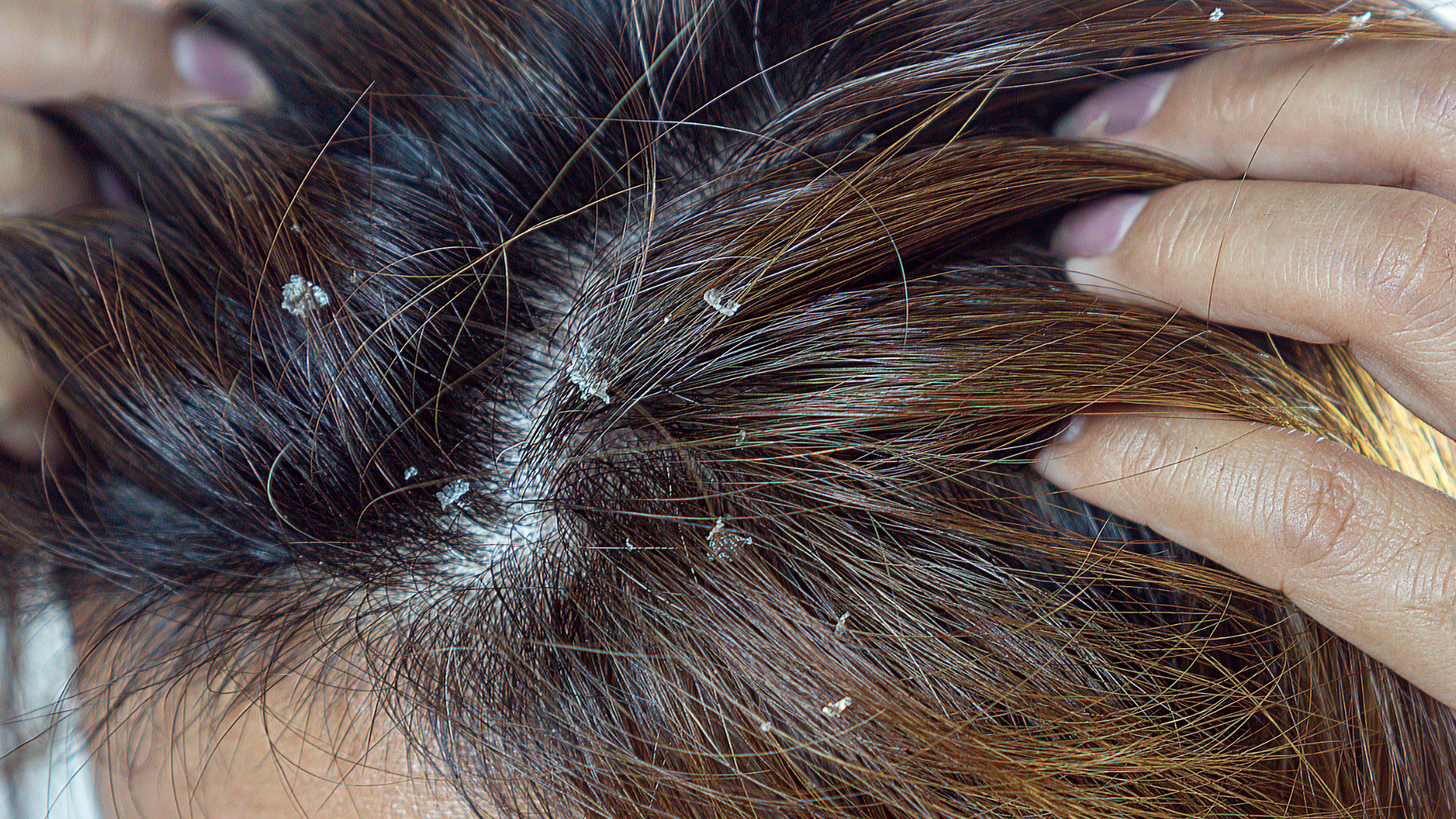 Piroctone Olamine: The Answer to Your Dandruff Woes?