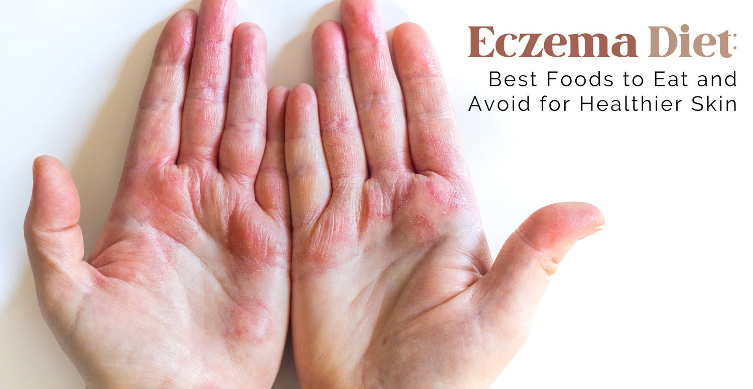 Eczema Diet: Best Foods to Eat and Avoid for Healthier Skin