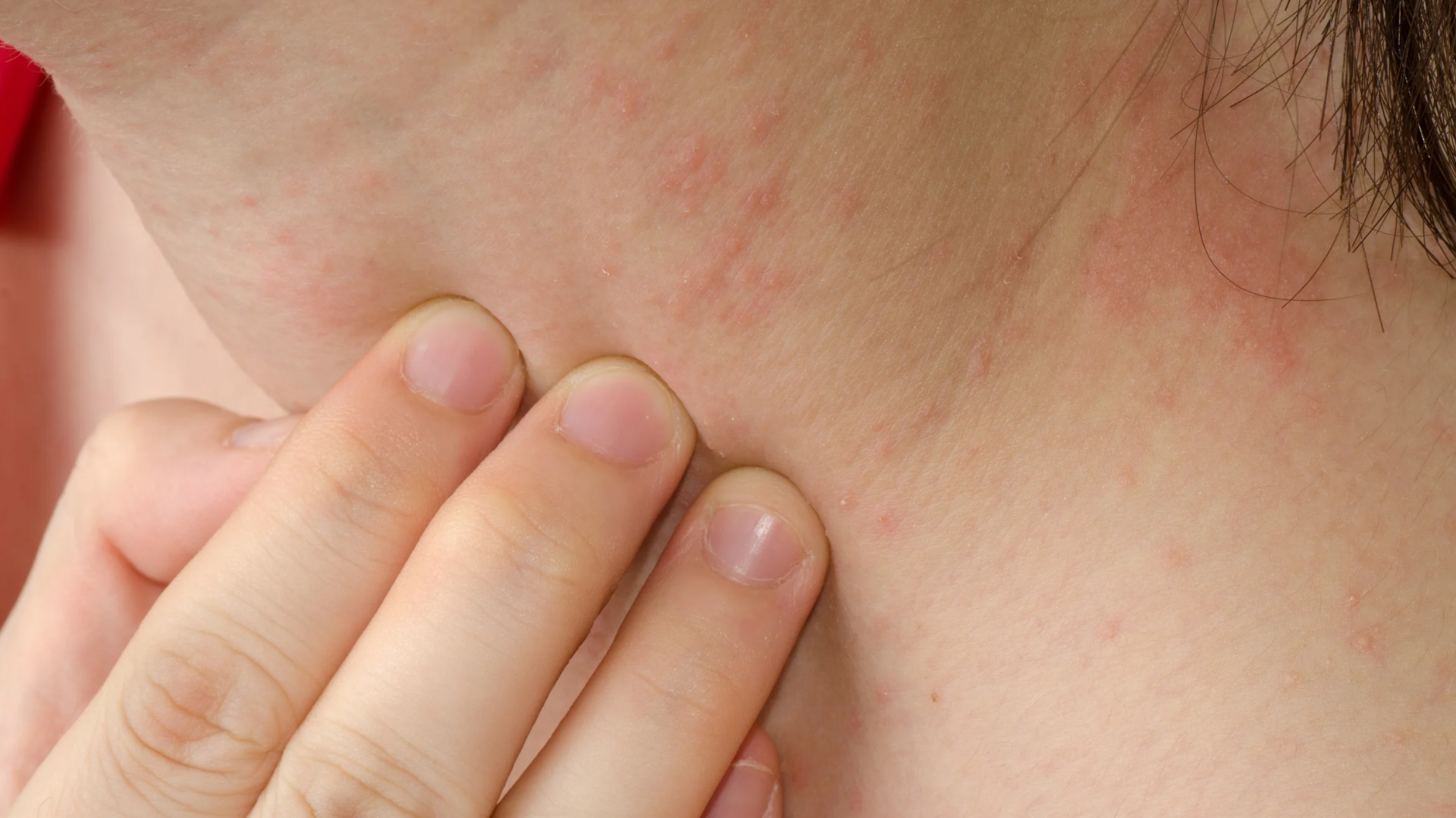 How do antidepressants affect your skin?