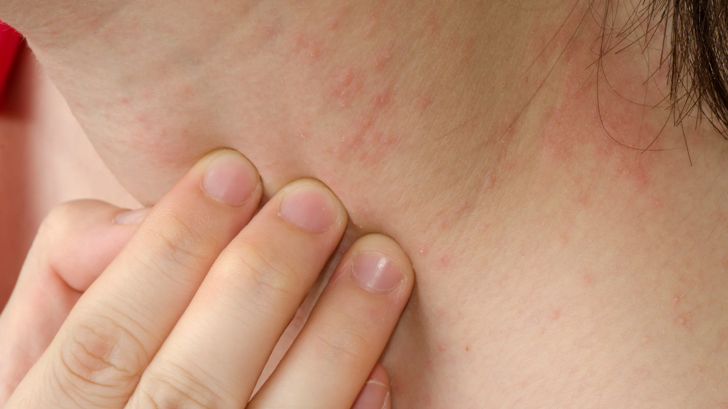 How do antidepressants affect your skin?