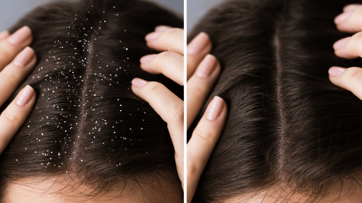 dandruff vs dry scalp 
