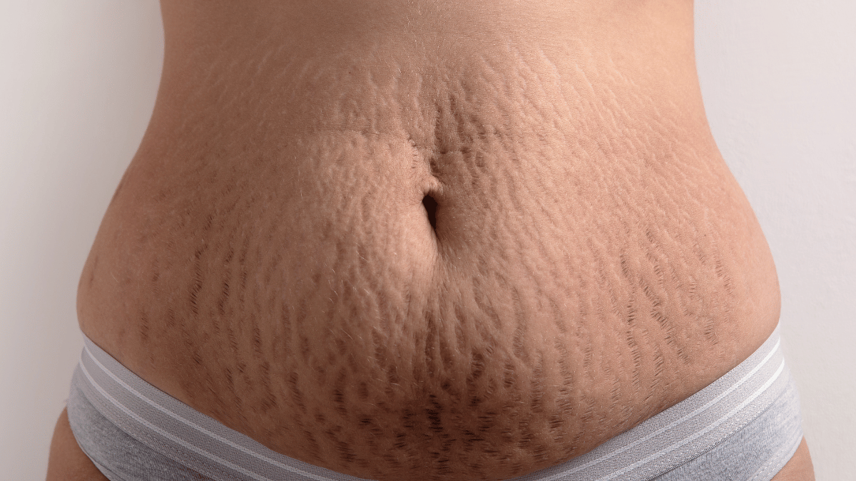 Stretch Marks: Causes, Treatment, & Home Remedies