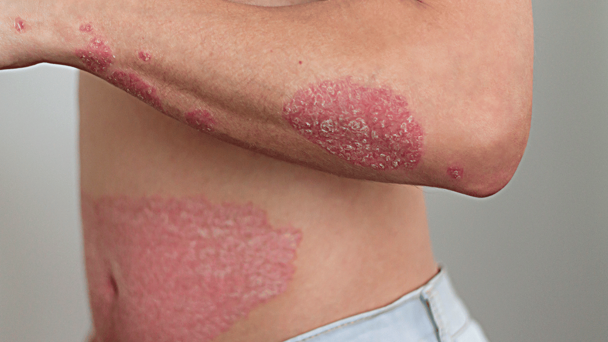 psoriasis treatment