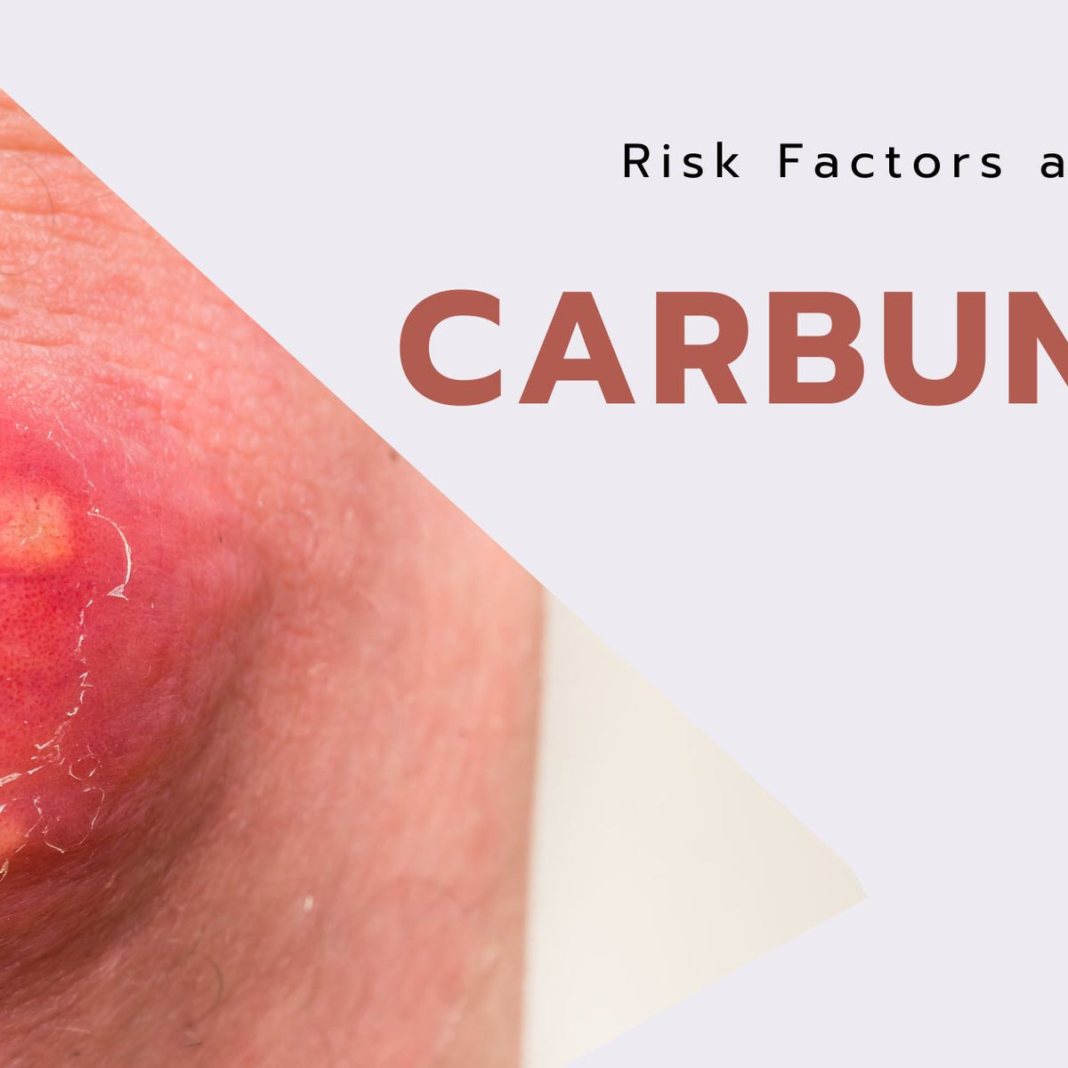 Carbuncle Pictures Causes Symptoms And Treatment Risk Factors And