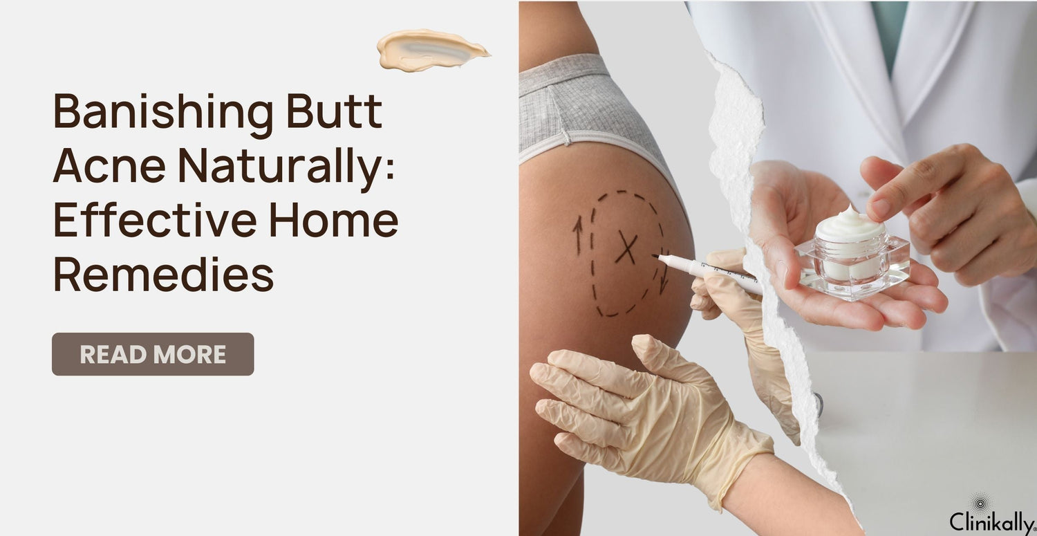 Banishing Butt Acne Naturally: Effective Home Remedies