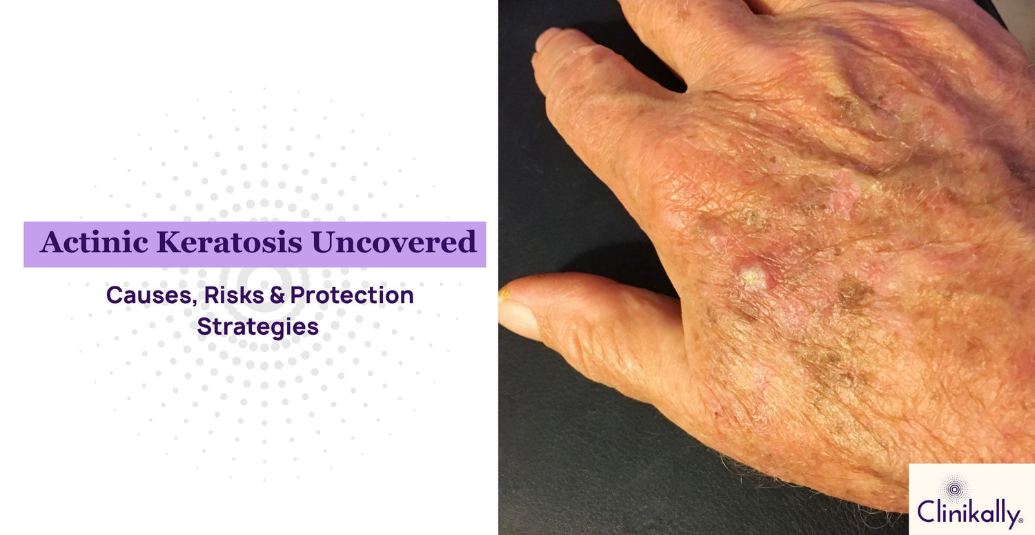 Actinic Keratosis Uncovered: Causes, Risks & Protection Strategies