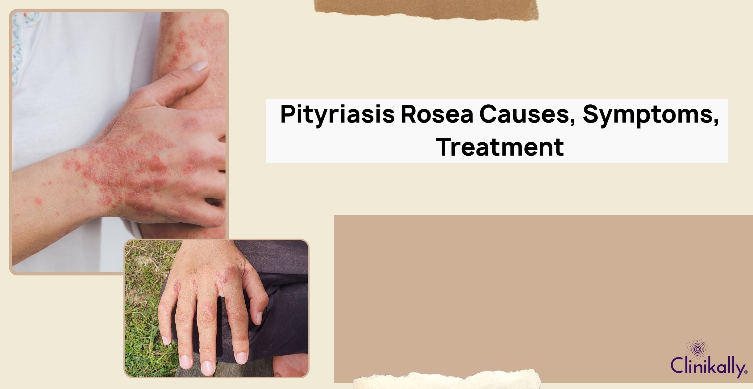 Pityriasis Rosea Causes, Symptoms, Treatment