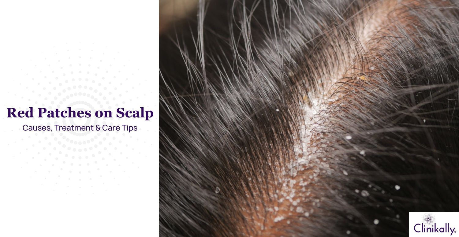 Red Patches on Scalp: Causes, Treatment and Care Tips