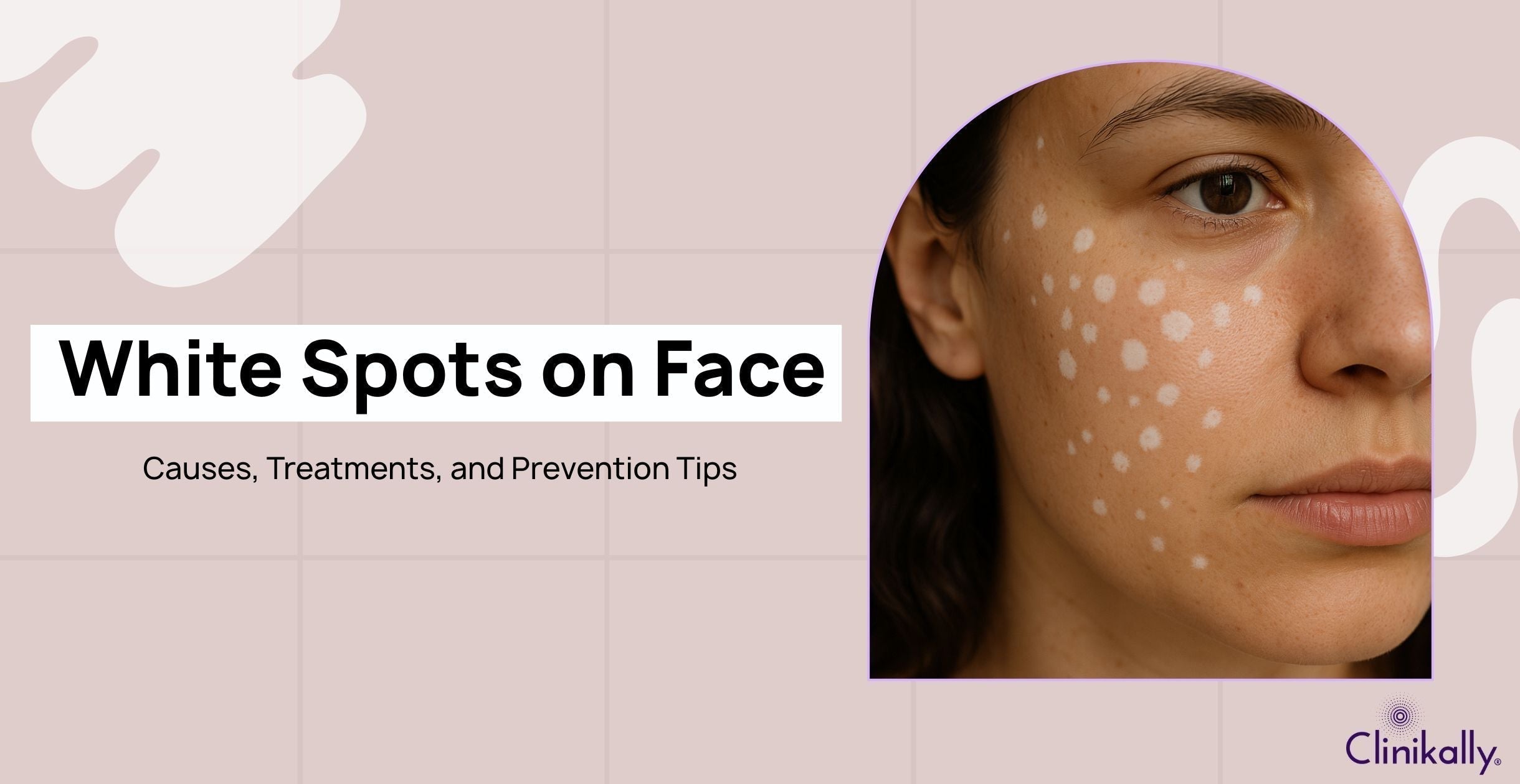 White Spots on Face: Causes, Treatments, and Prevention Tips