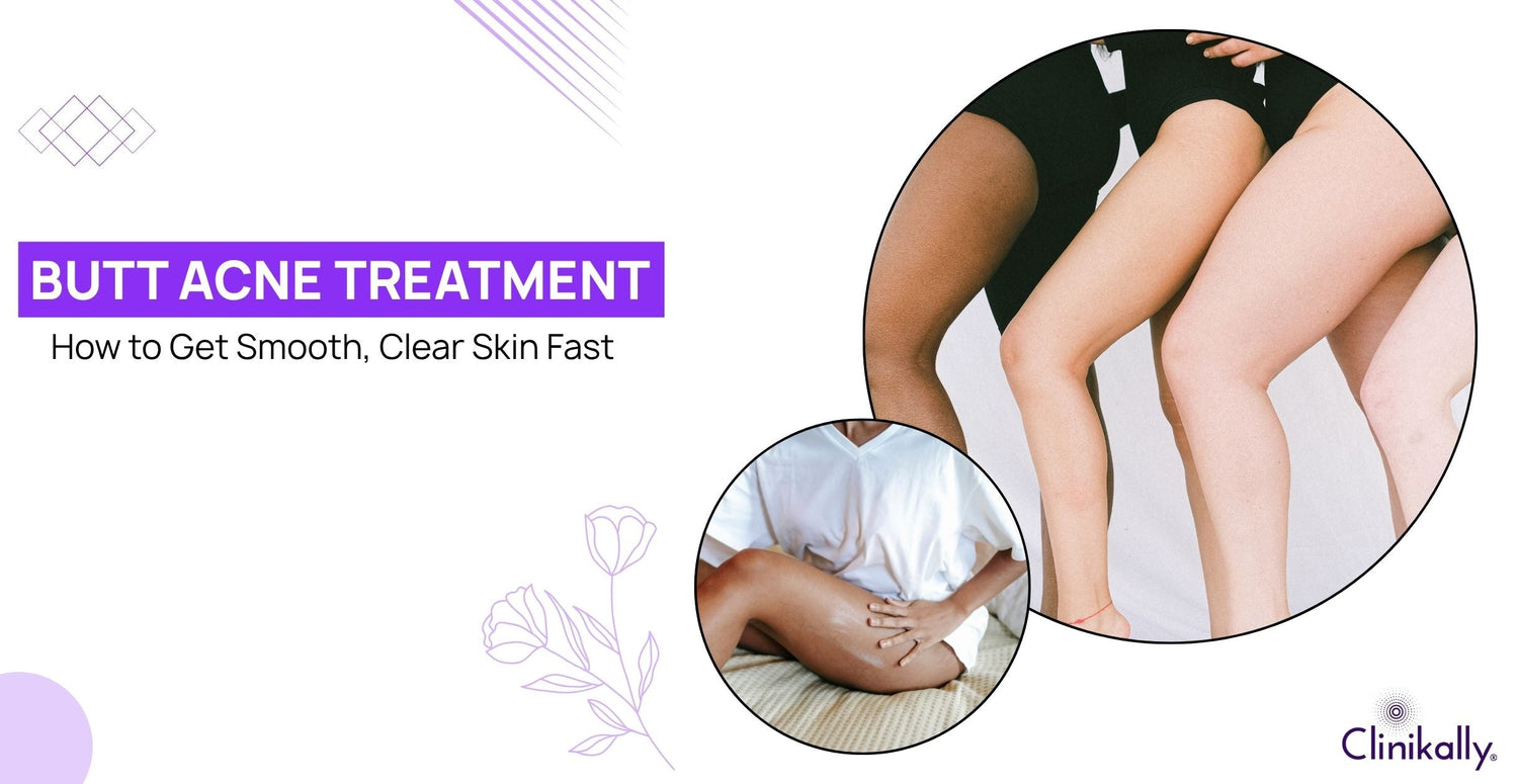 Butt Acne Treatment: How to Get Smooth, Clear Skin Fast