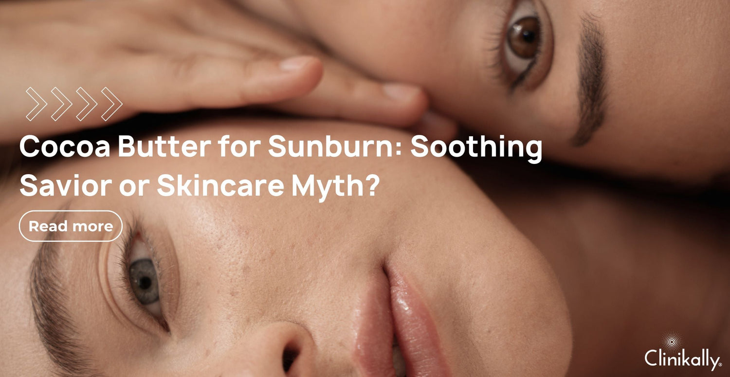 Cocoa Butter for Sunburn: Soothing Savior or Skincare Myth?