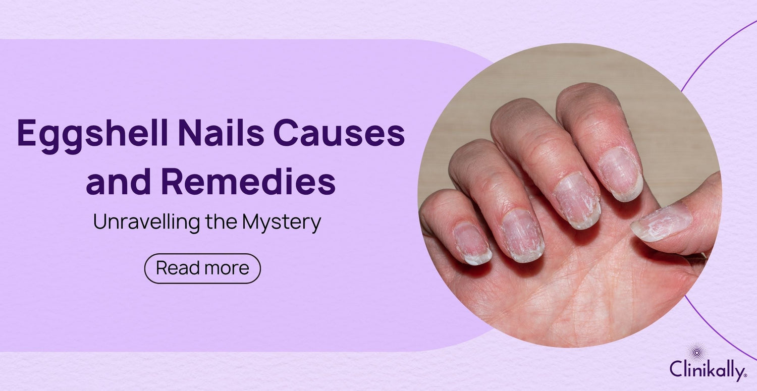 Eggshell Nails Causes and Remedies: Unravelling the Mystery