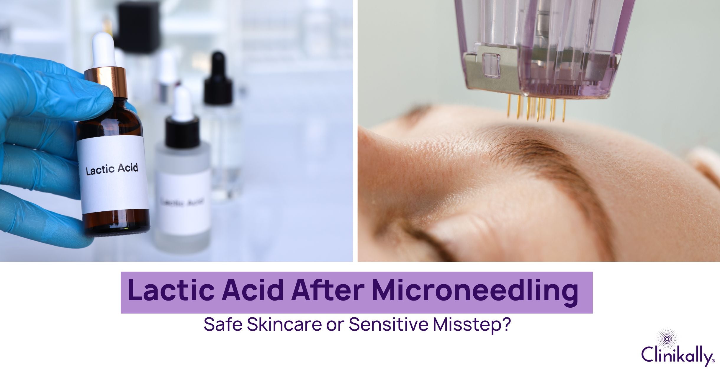 Lactic Acid After Microneedling: Safe Skincare or Sensitive Misstep?