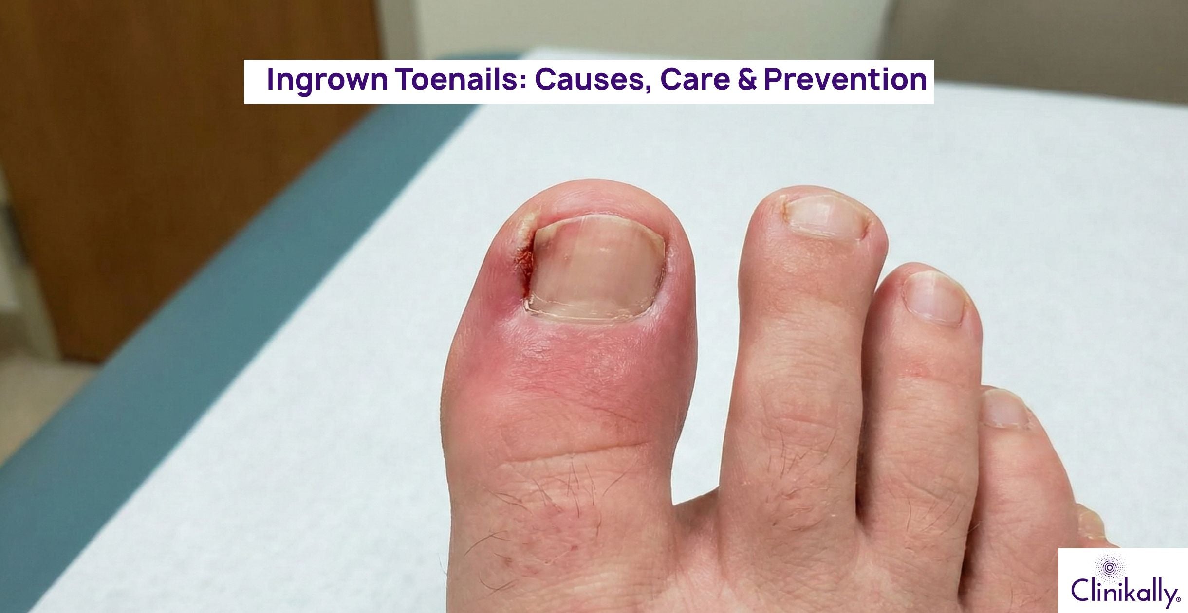 Ingrown Toenails: Causes, Care & Prevention