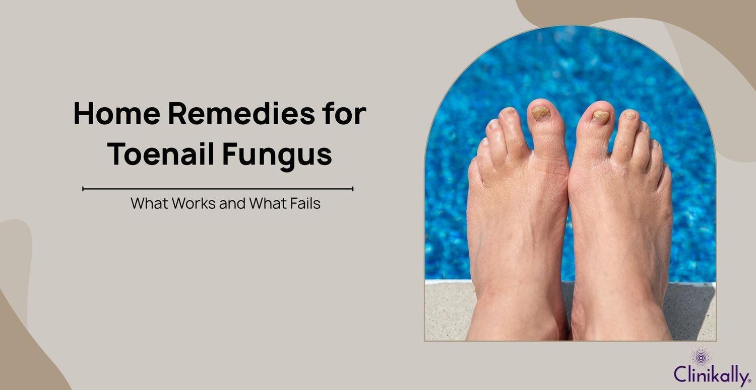 Home Remedies for Toenail Fungus: What Works and What Fails