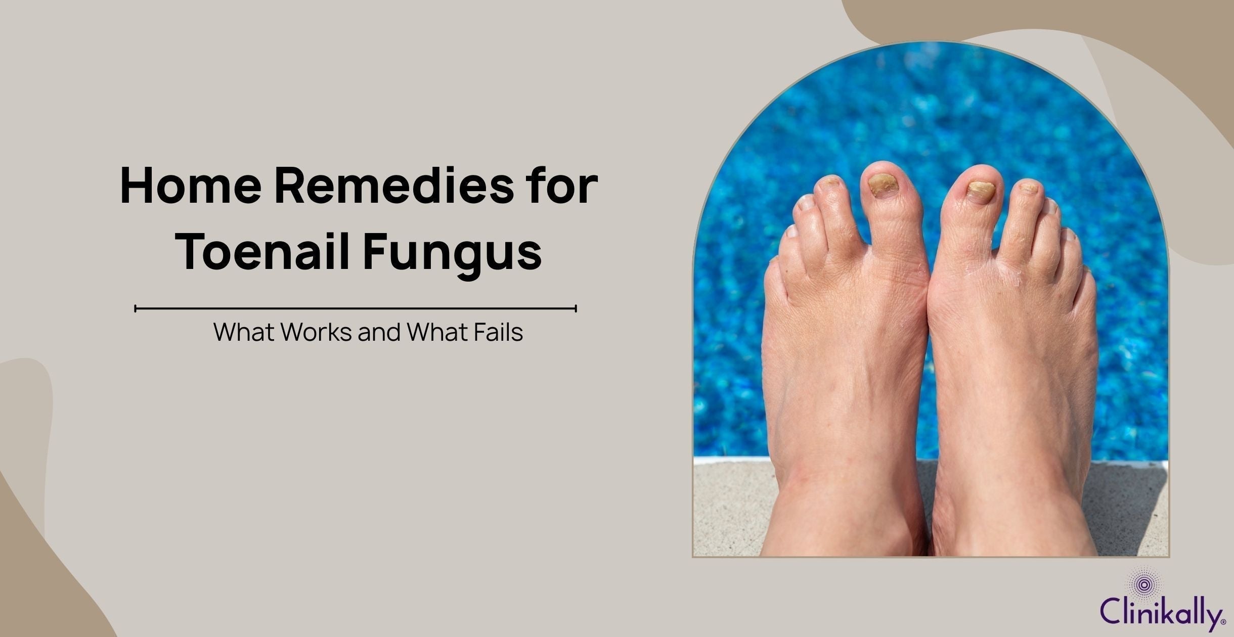 Home Remedies for Toenail Fungus: What Works and What Fails
