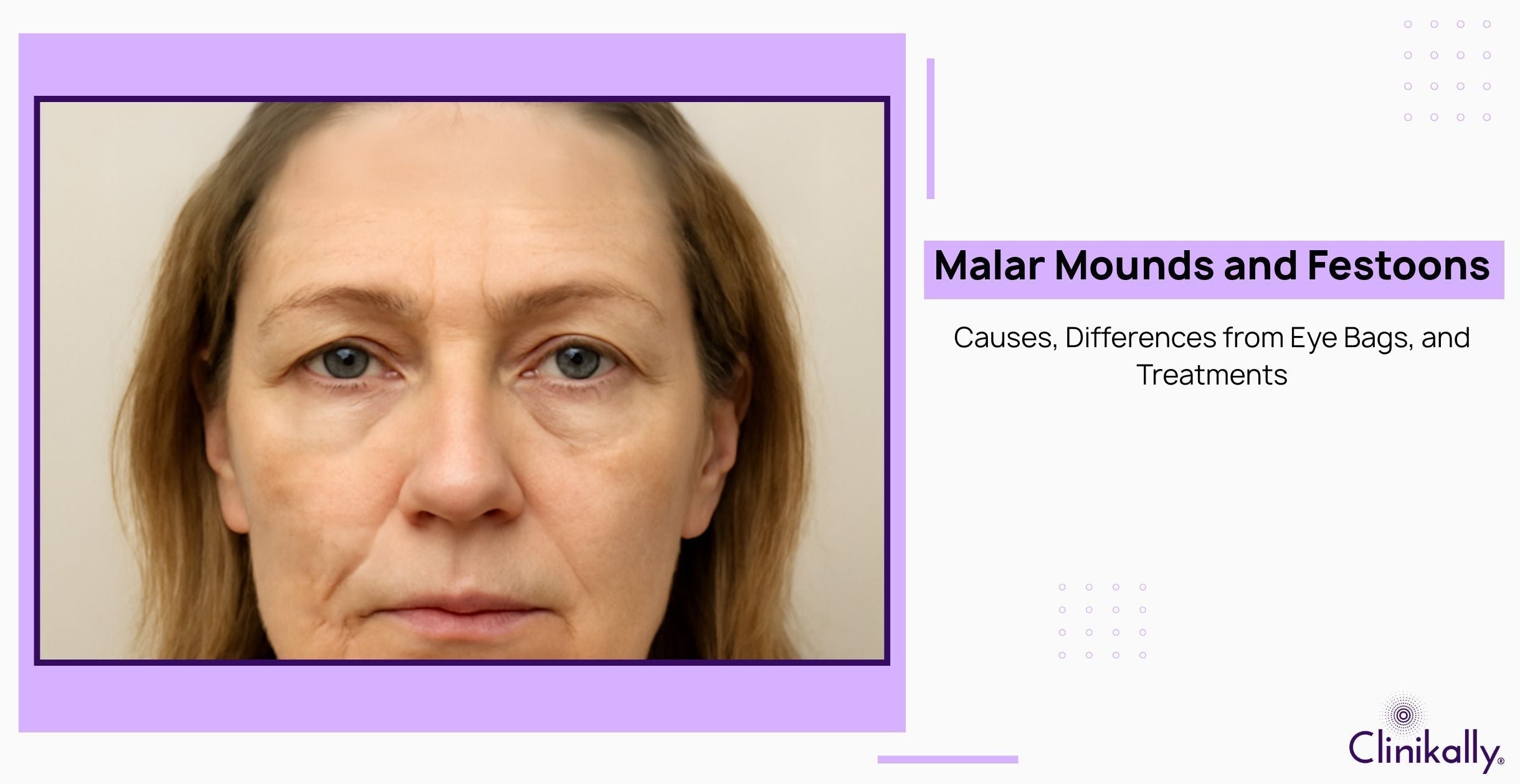 Malar Mounds and Festoons: Causes, Differences from Eye Bags, and Treatments