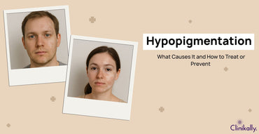 Hypopigmentation: What Causes It and How to Treat or Prevent