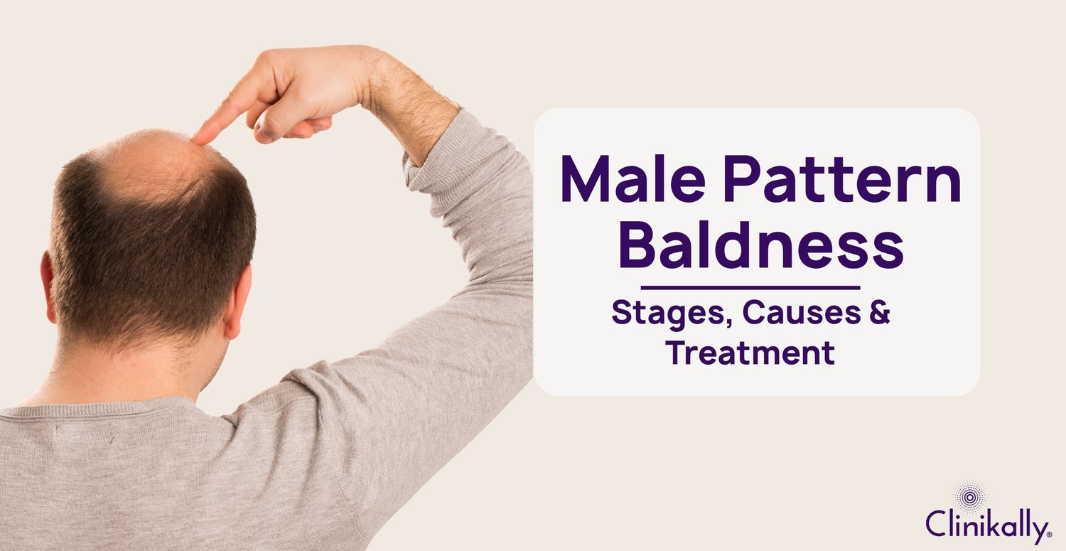 Male Pattern Baldness, Stages, Causes, & Treatment