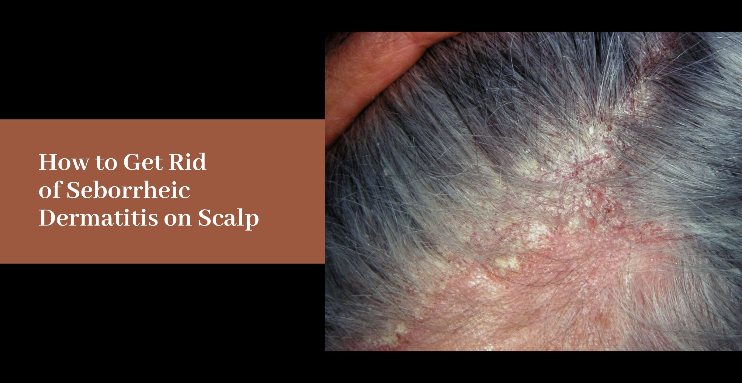 Mild Seborrheic Dermatitis Scalp SEBORRHEIC DERMATITIS OF THE SCALP