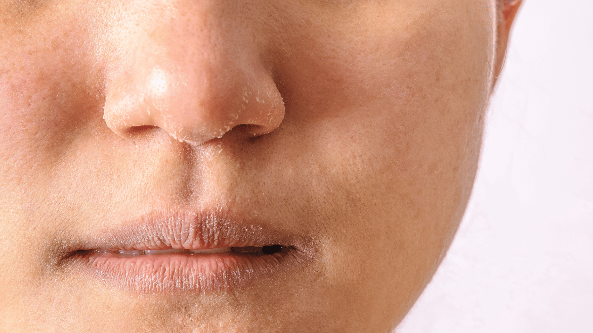 Rhinophyma (nose): Causes, 