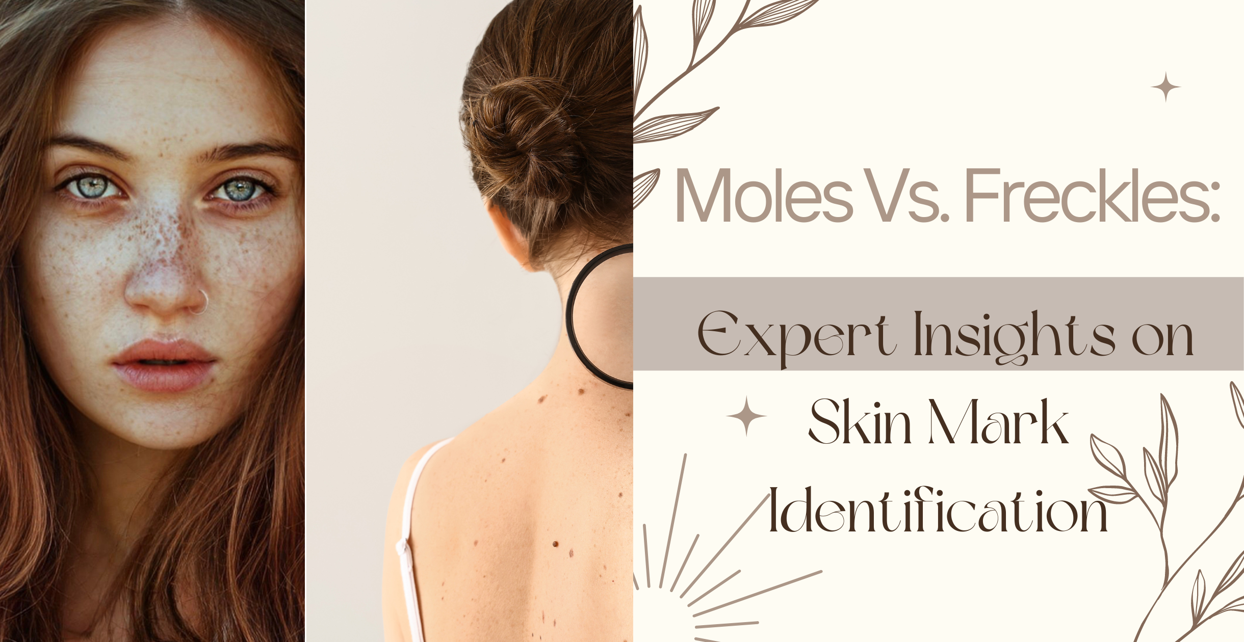 Moles Vs. Freckles: Expert Insights on Skin Mark Identification