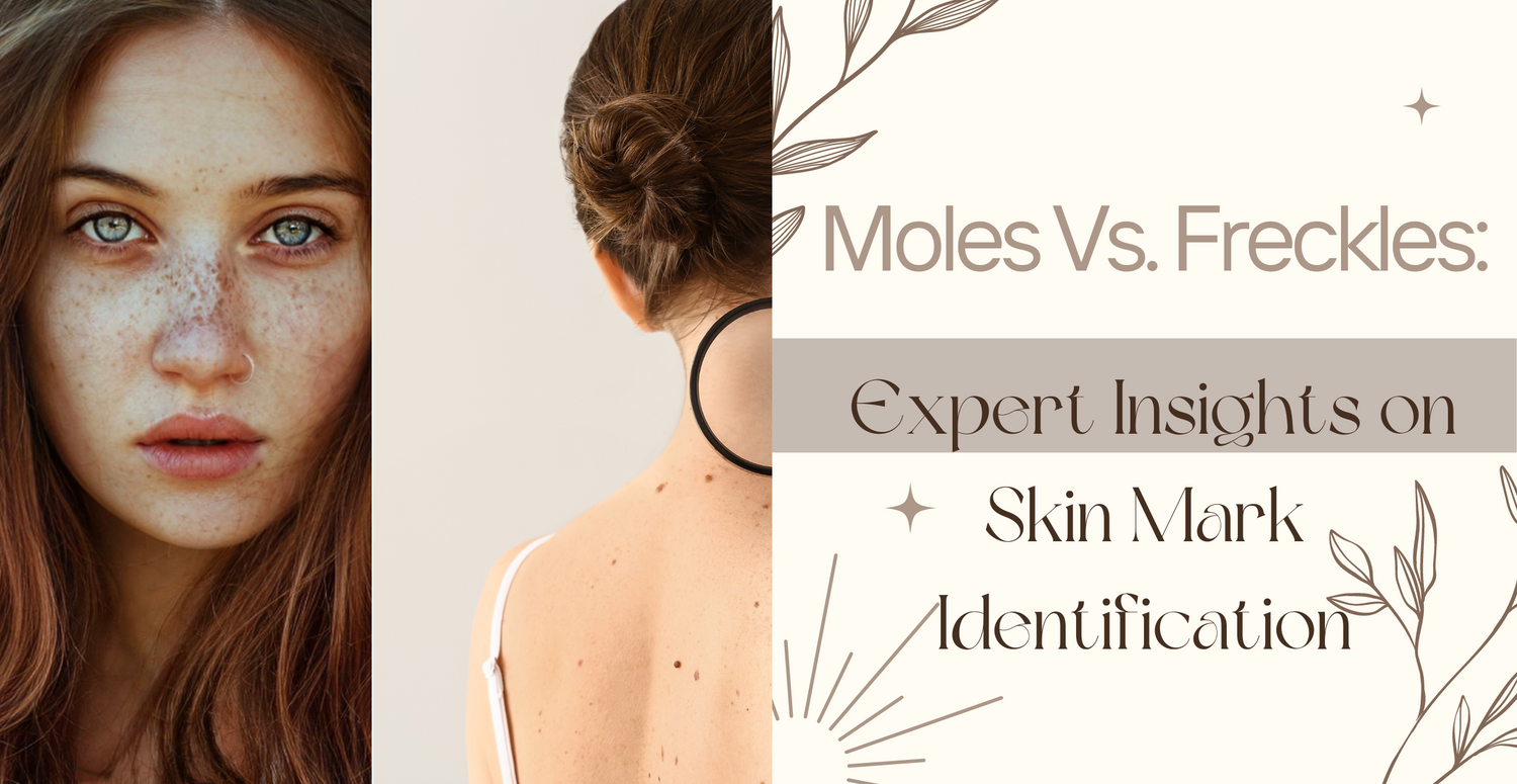 Moles Vs. Freckles Expert Insights on Skin Mark Identification