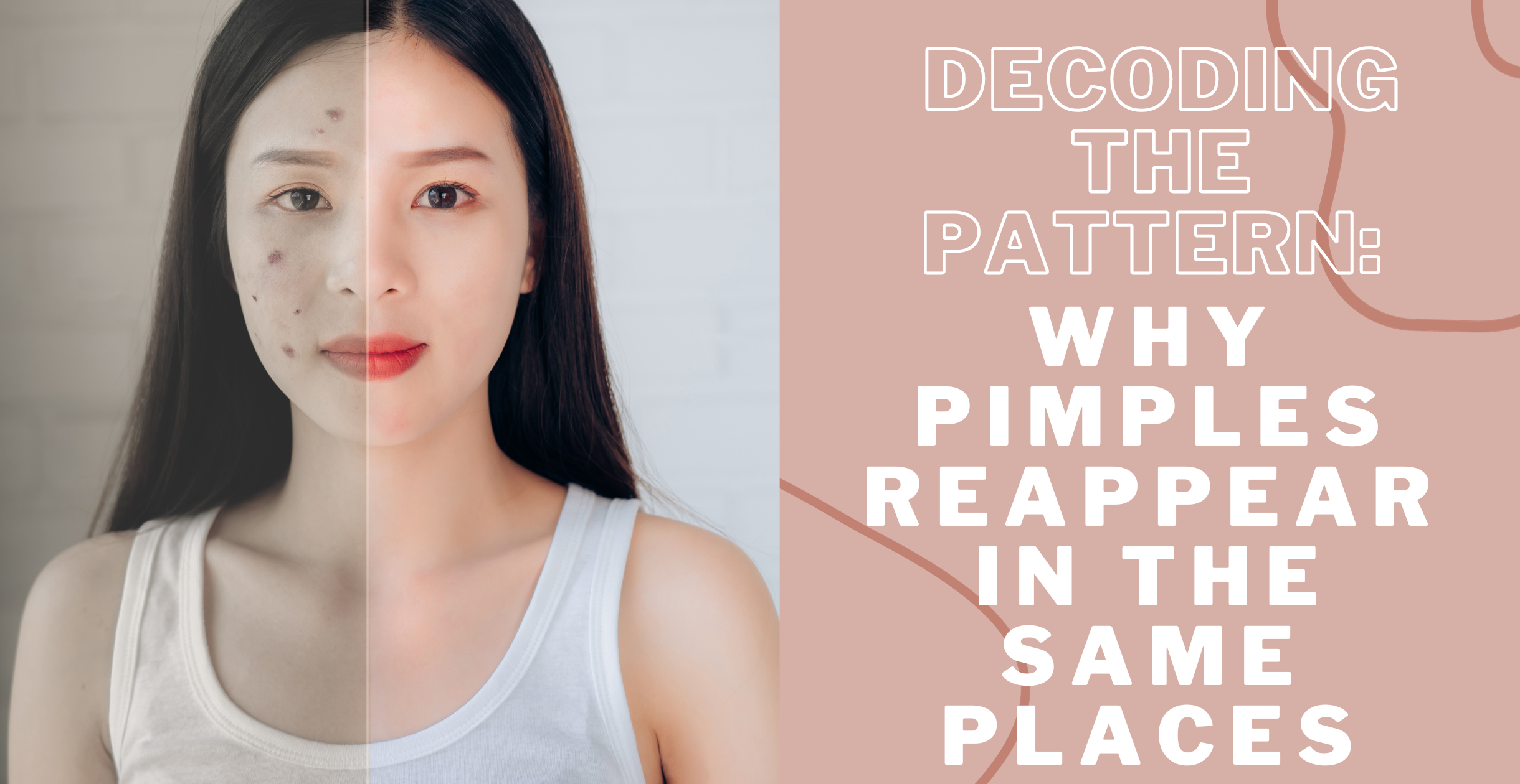 Decoding the Pattern: Why Pimples Reappear in the Same Places