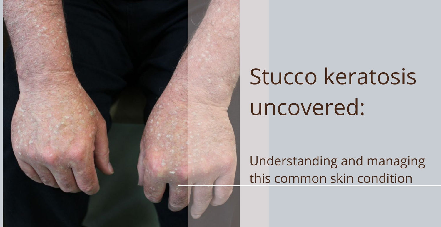 Stucco keratosis uncovered: Understanding and managing this common skin condition