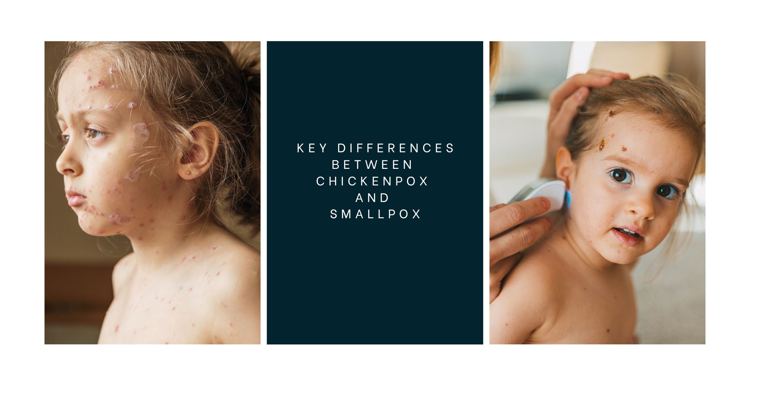Key Differences Between Chickenpox and Smallpox | Clinikally