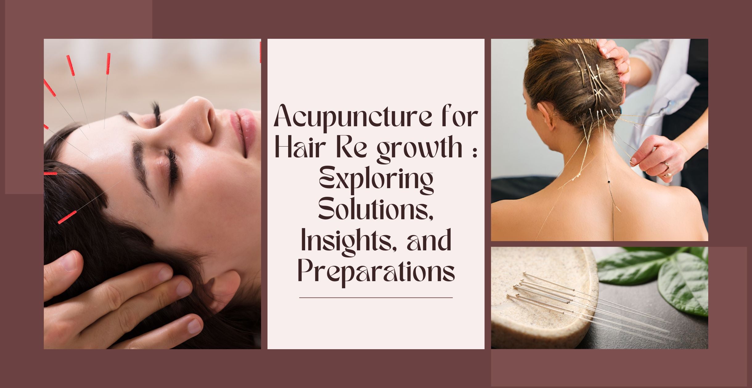 Acupuncture for Hair Re growth : Exploring Solutions, Insights, and Preparations