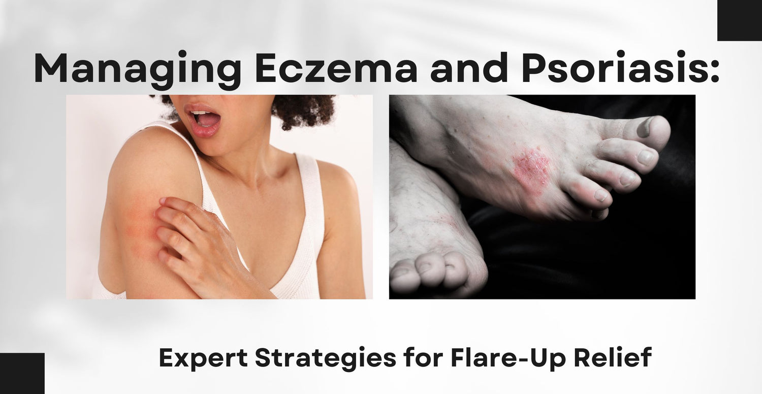 Managing Eczema and Psoriasis: Expert Strategies for Flare-Up Relief