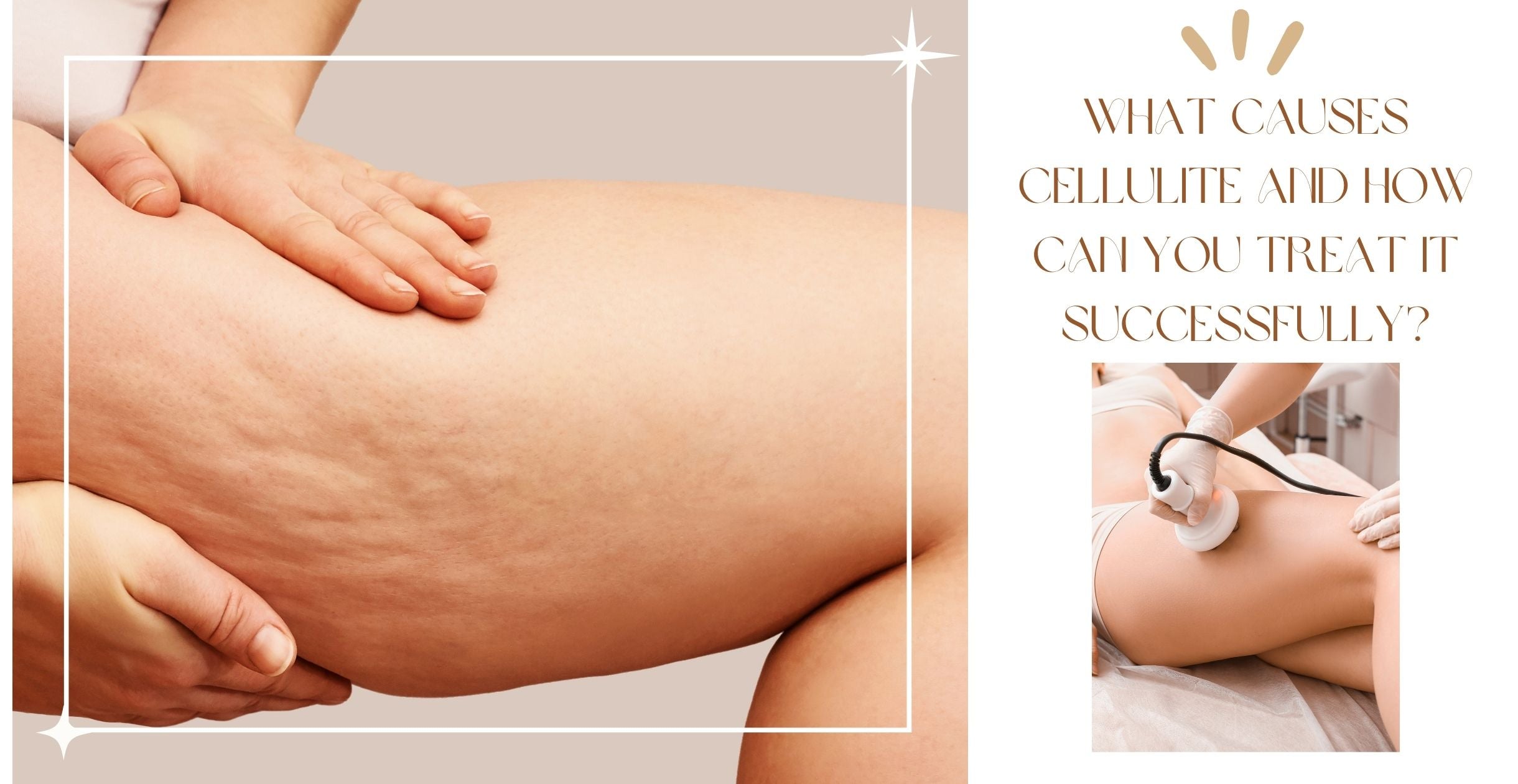 What Causes Cellulite and How Can You Treat It Successfully?