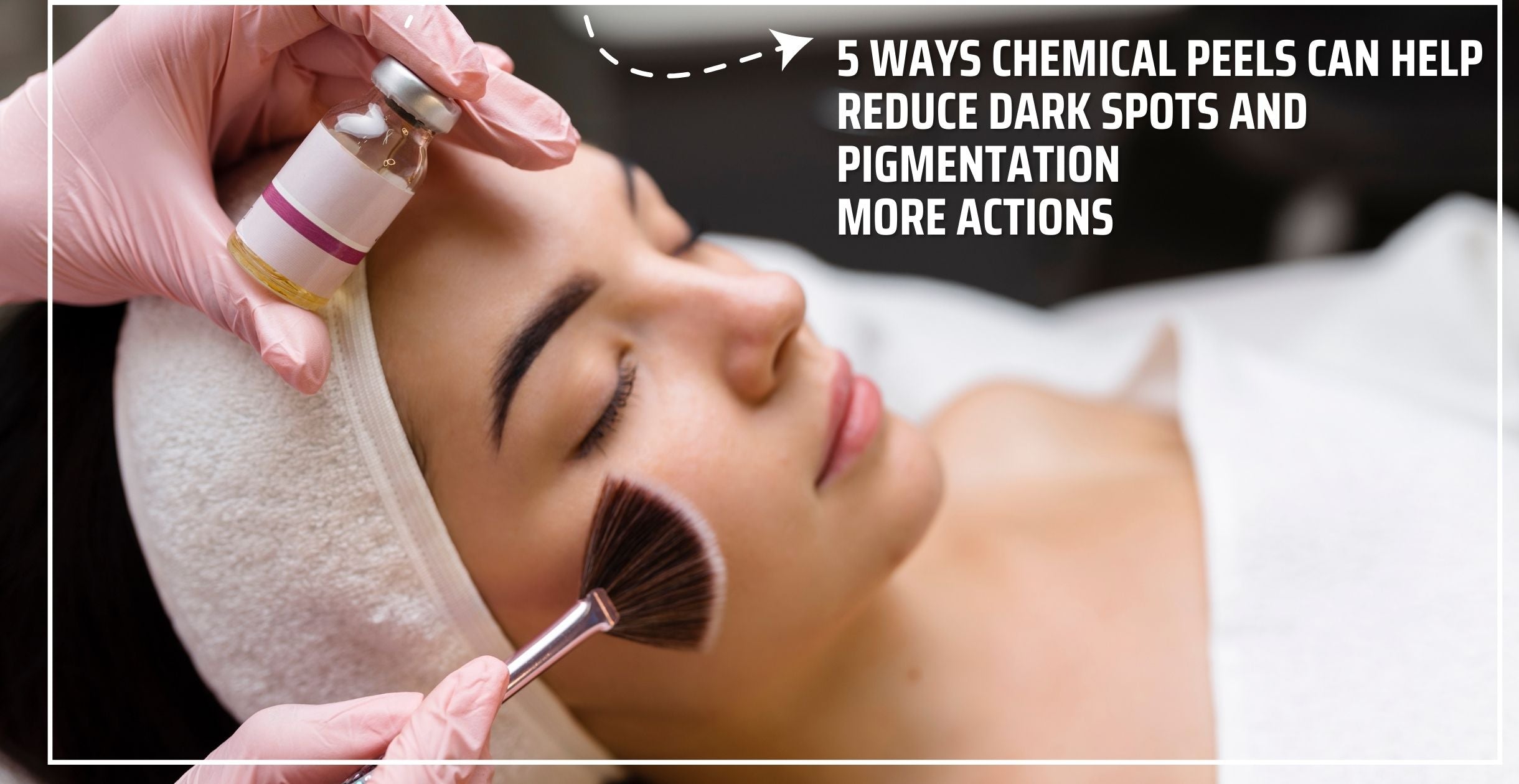 5 Ways Chemical Peels Can Help Reduce Dark Spots and Pigmentation