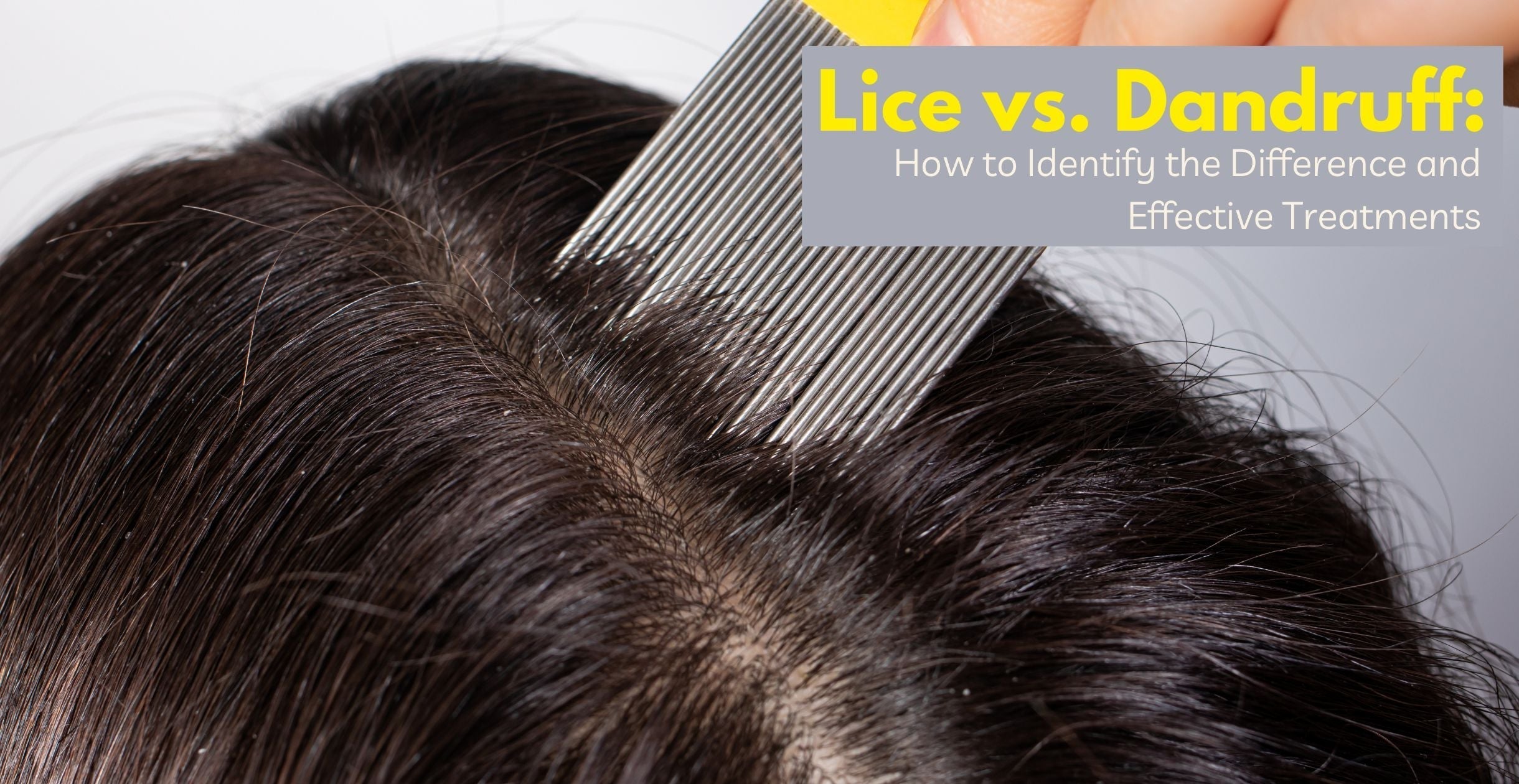  Lice vs. Dandruff: How to Identify the Difference and Effective Treatments