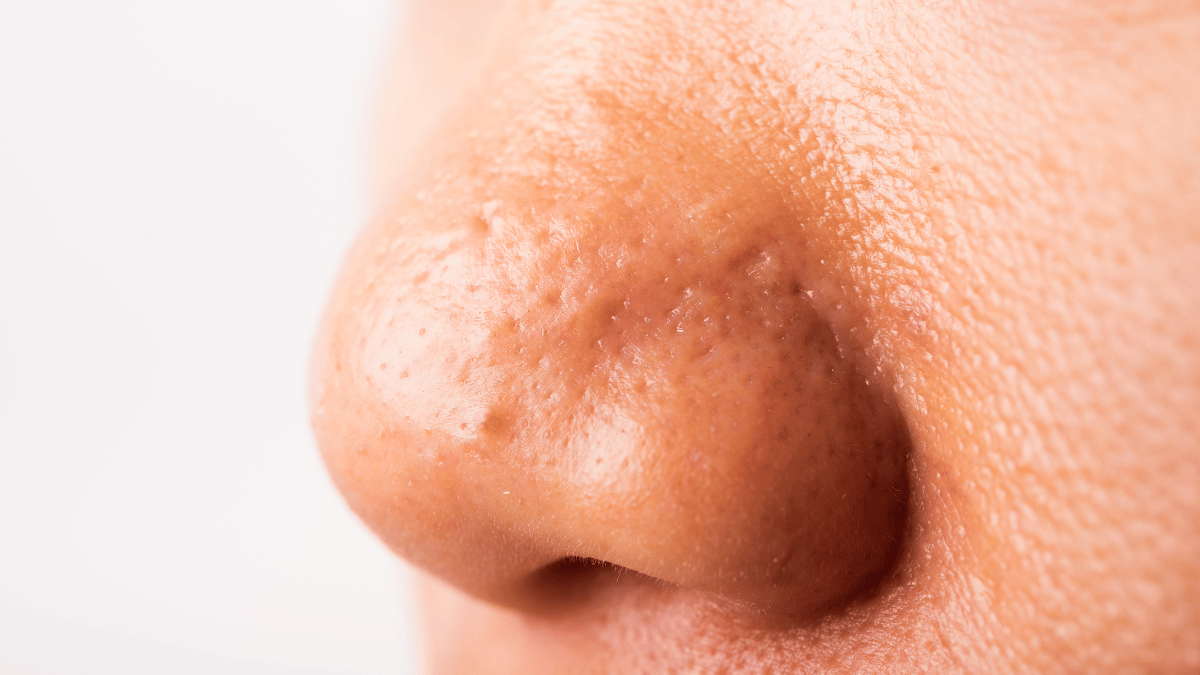 How do you treat a pimple in your nose?