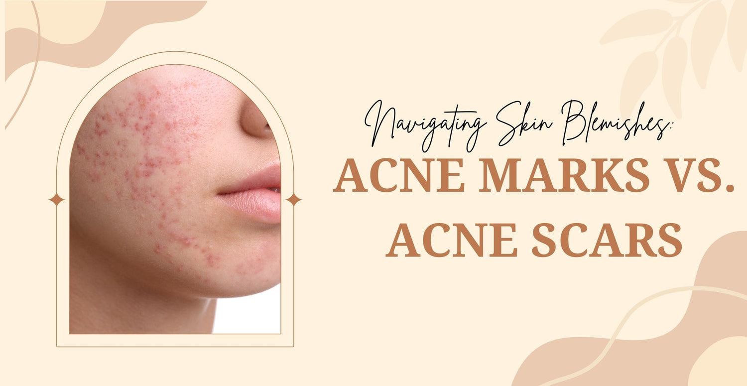 Navigating Skin Blemishes: Acne Marks vs. Acne Scars