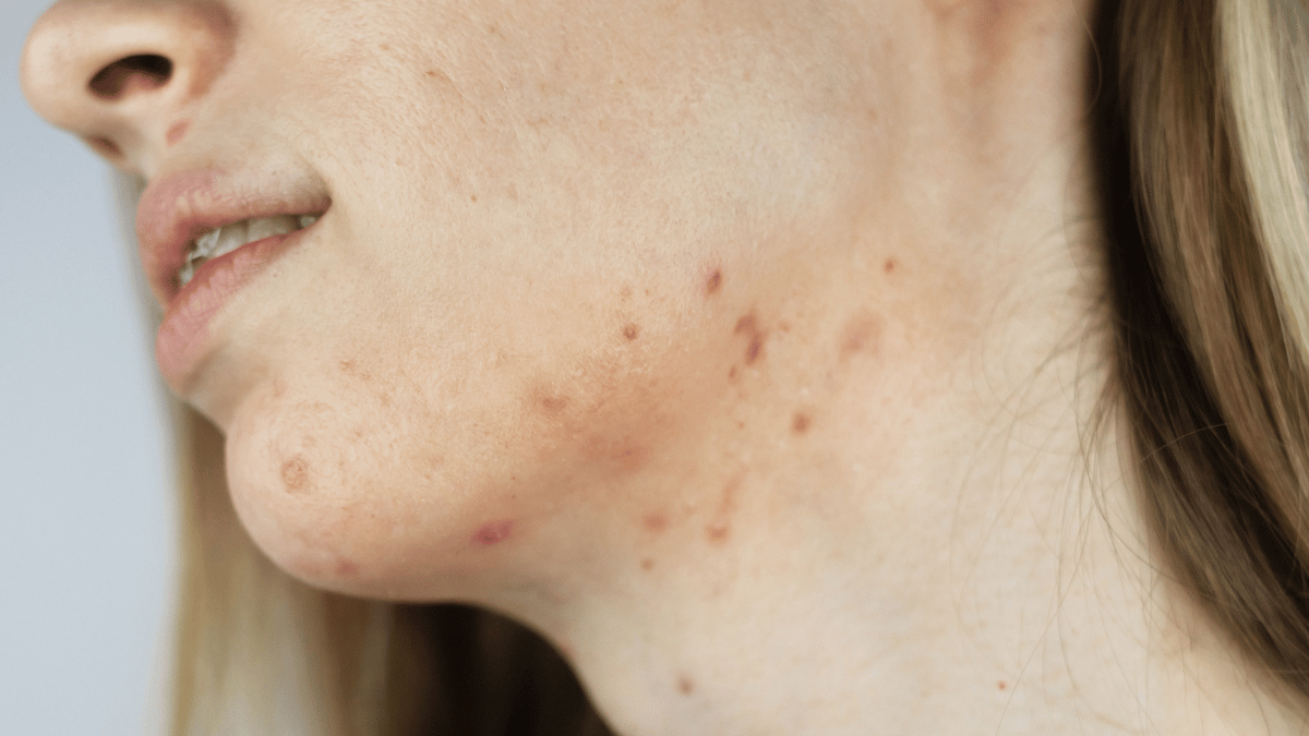 Clear Skin Journey: Discover the 5 Best Face Washes for Pimples