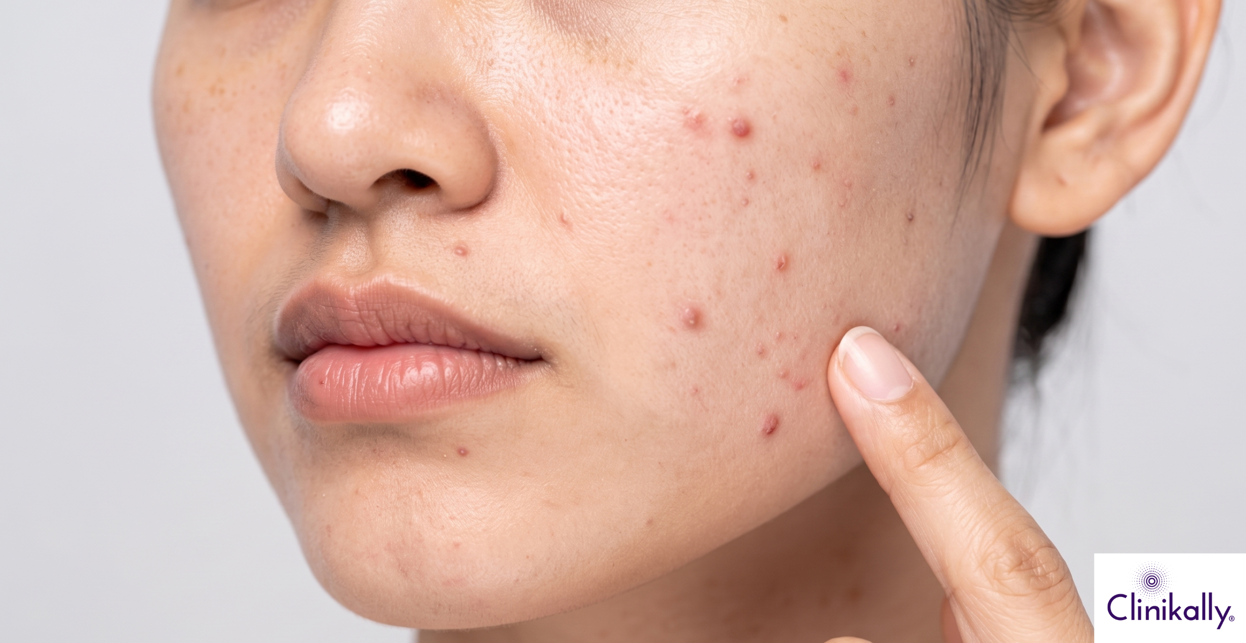Close up of hormonal acne caused by PMOS