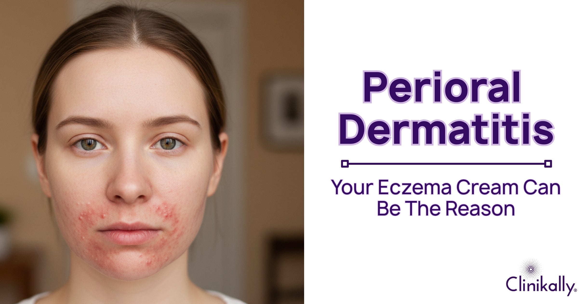 Your Eczema Cream Might Be Causing You Perioral Dermatitis