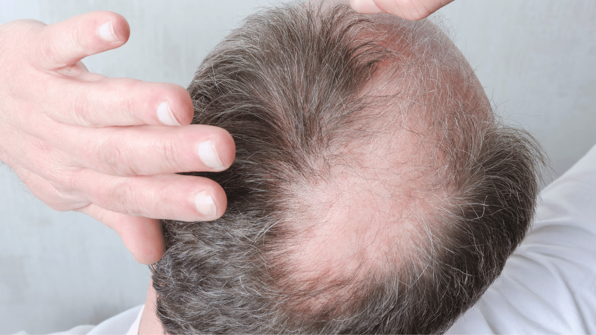 Procapil vs. Redensyl for Hair Fall (Doctor's Guide) | Clinikally