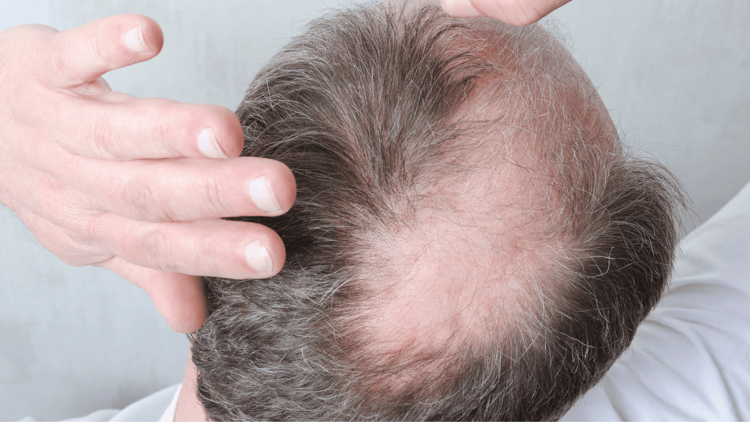 What Happens After You Stop Minoxidil Use?