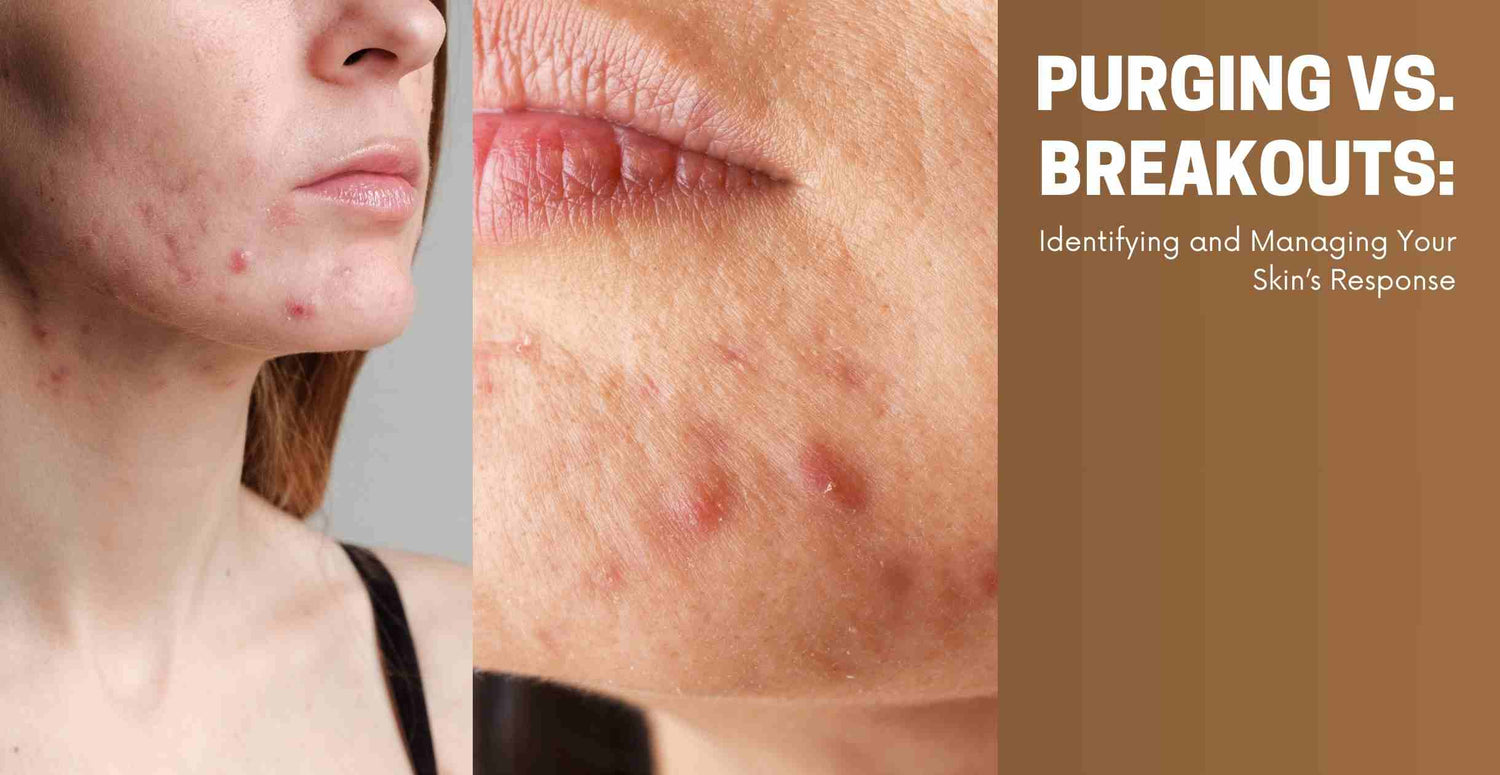 Purging vs. Breakouts: Identifying and Managing Your Skin’s Response