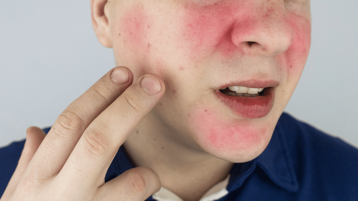 How to Get Rid of Rosacea: Causes, Treatment & Home Remedies