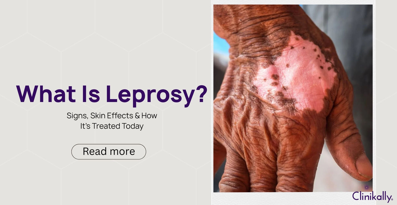 What Is Leprosy? Signs, Skin Effects & How It’s Treated Today