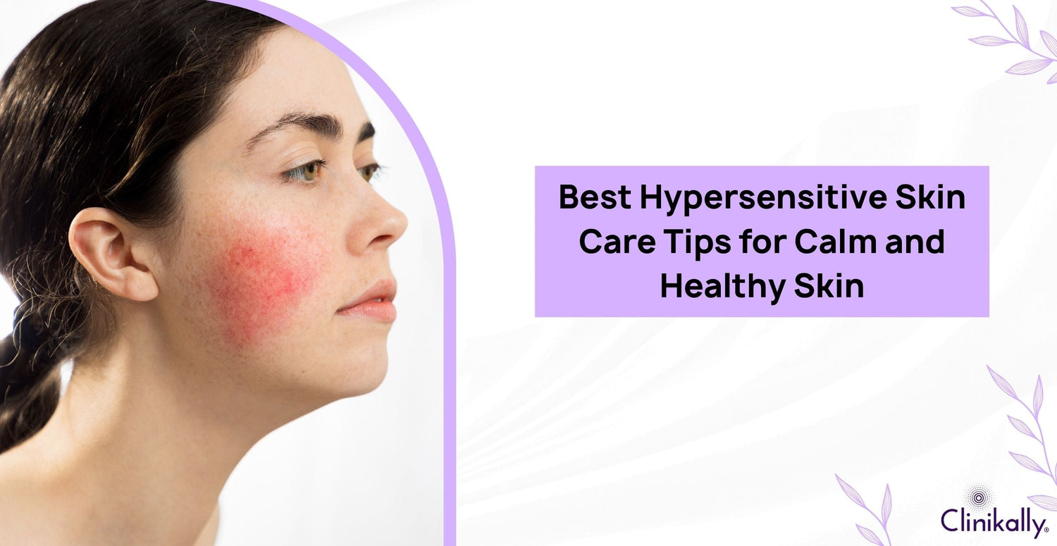 Best Hypersensitive Skin Care Tips for Calm and Healthy Skin