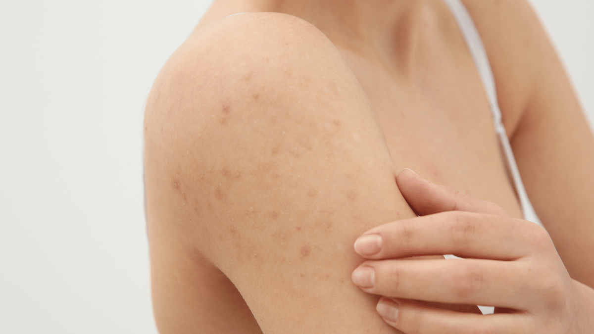 Scabies rash
